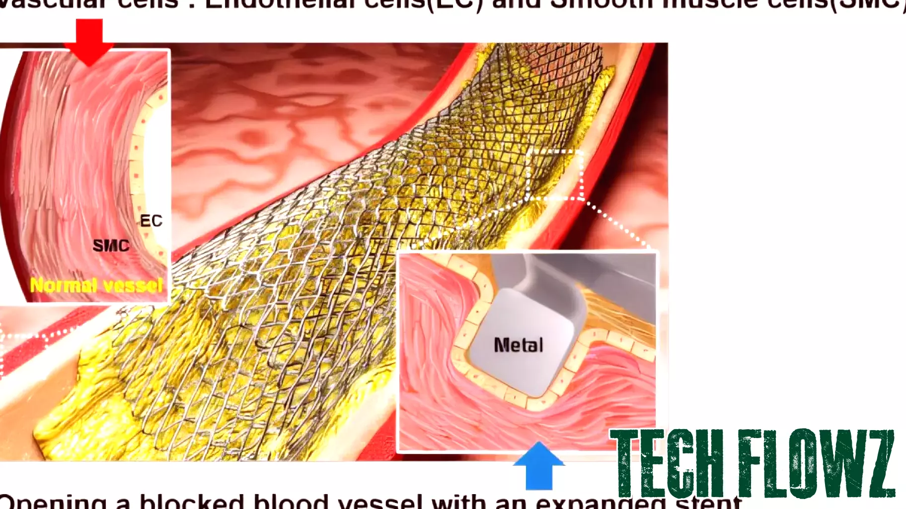 Innovative Laser Technology Enhances Stent Performance in Vascular Treatments