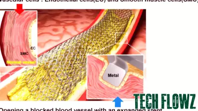 Innovative Laser Technology Enhances Stent Performance in Vascular Treatments